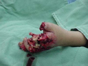 LESION (42)  IMAGENES FOTOS